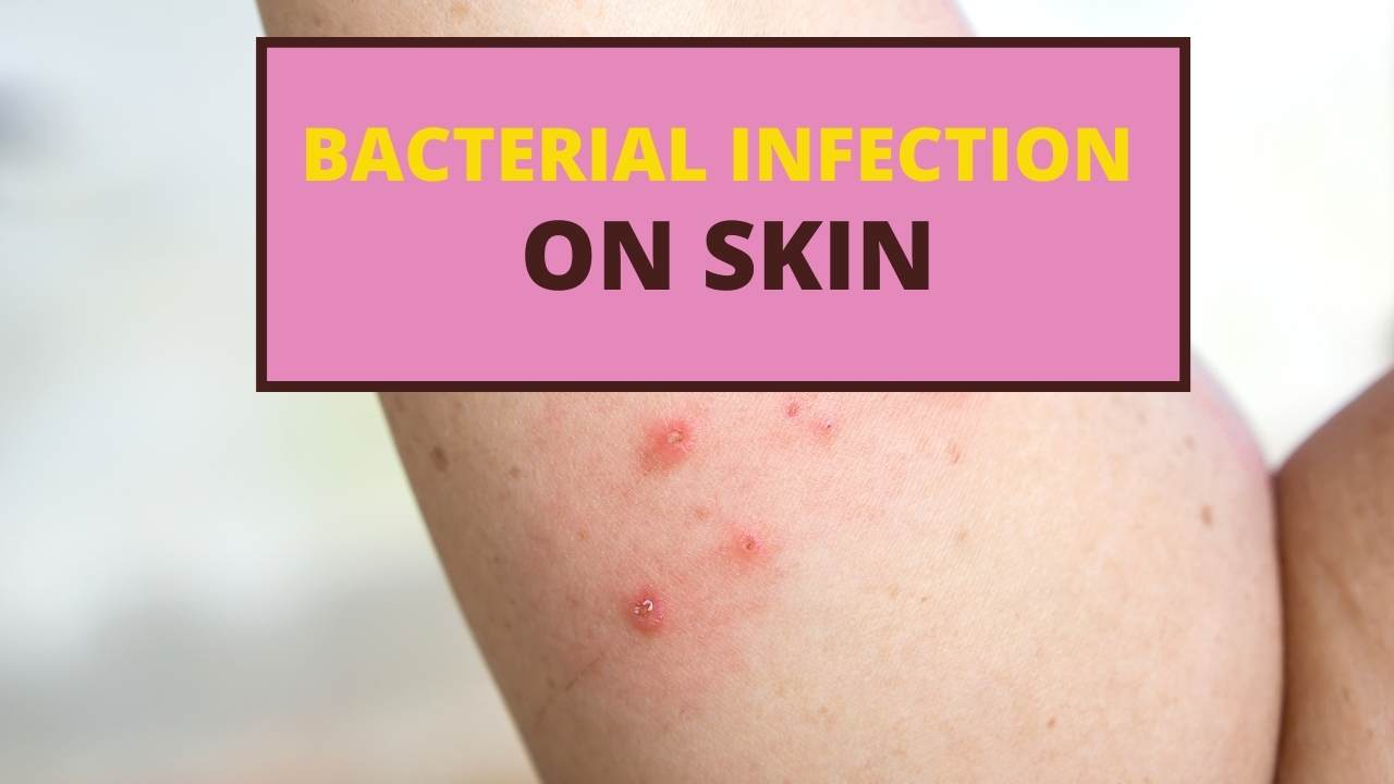 bacterial infection on skin