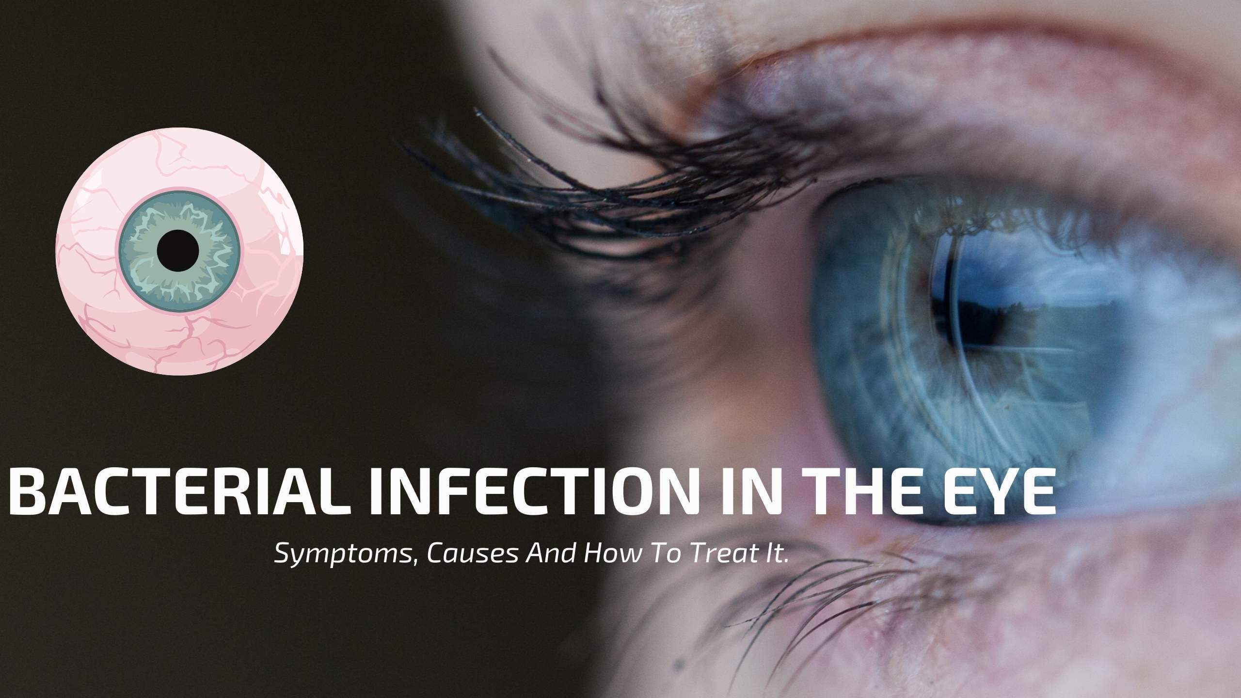 Bacterial Infection In The Eye